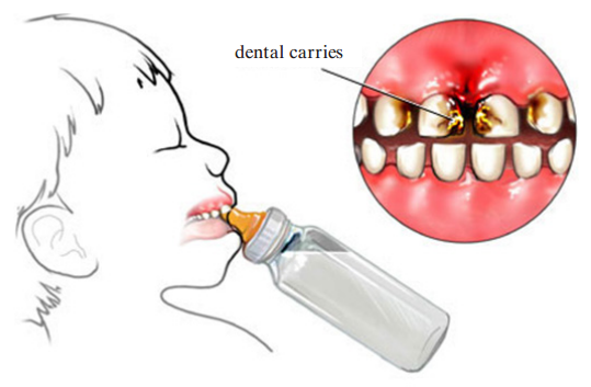 Dental carries